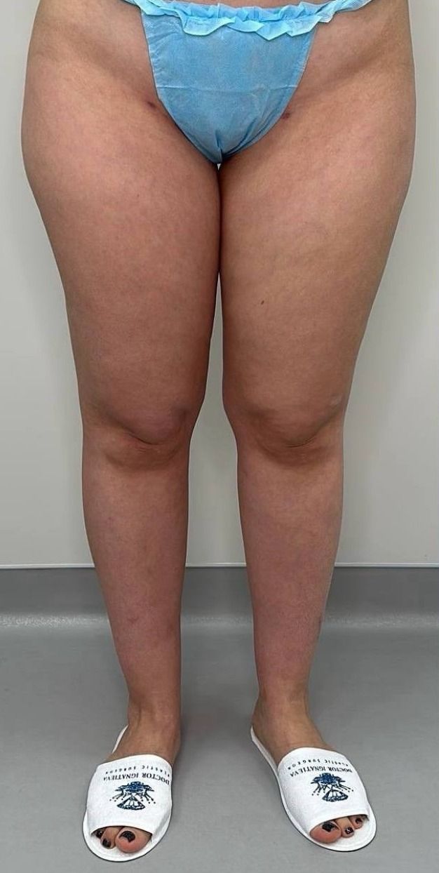 Lipedema before treatment: the patient’s legs from the front — heavy thighs and knees