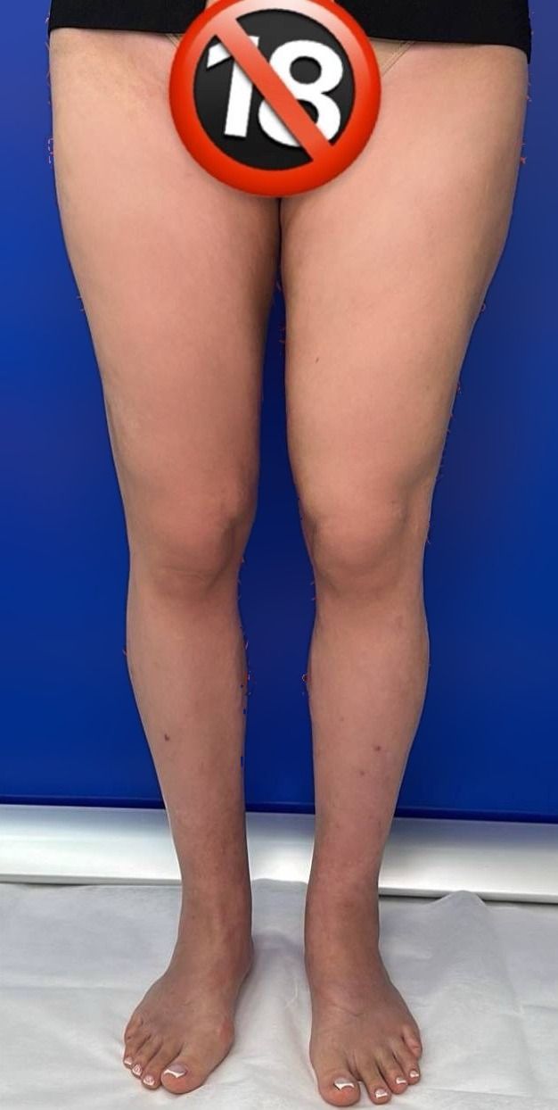 Lipedema treatment before and after: the patient’s legs from the front after surgery — less volume on the thighs, defined knees and calves